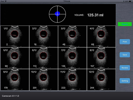 Comparison of Bladder scanner and B scanner's Diagnosis Effect